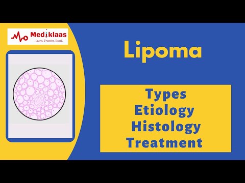 Lipoma - Types, Etiology, Histology and  Treatment l General surgery l Mediklaas