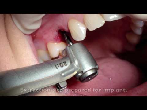 Immediate Load Implant