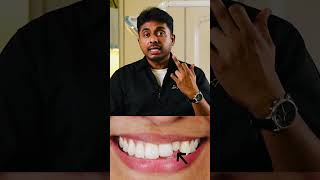 #ceramicveneers #smilemakeover #chennaidentist #dentist #smiledentist #porcelainveneers