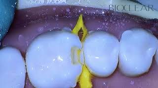 Bioclear Matrix | The Bioclear Class II Prep using Komet Burs