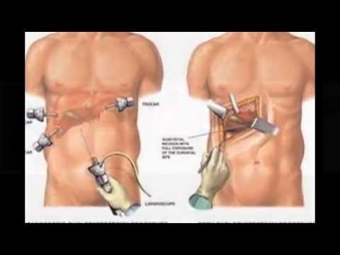 Bone Marrow Transplant India