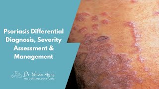 Lecture 4: Psoriasis Differential Diagnosis, Severity Assessment & Management