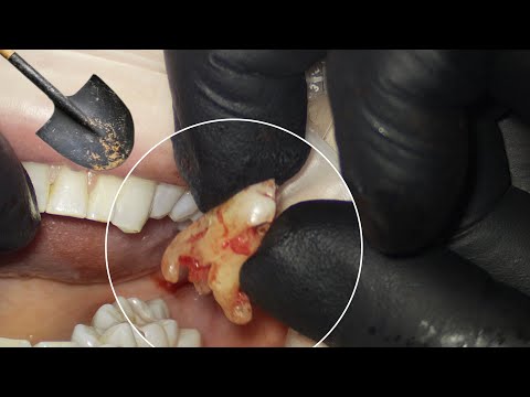 Husband Pulls Out Wife’s Tooth – A Bloody Finale That Will Shock You!