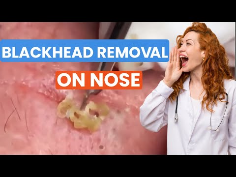 Blackhead Removal On Nose - Best Nose Pimple Popping | PIMPLE SPA