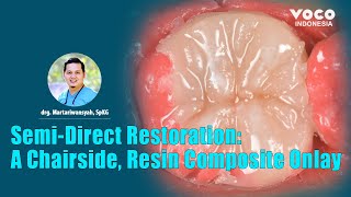 Semi-Direct Restoration: A Chairside, Resin Composite Onlay ǀ Die Silicone & Polofil NHT (VOCO GmbH)