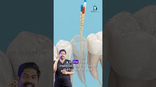 மீண்டும் மீண்டும் வேர் சிகிச்சையா? - Re-RCT | Dr. Karthikeyan | Denta Kings