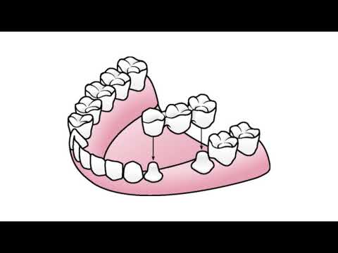FAQ - What is a dental bridge? | Avanti Dentistry | Restorative Dentistry