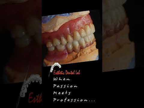#esthetics #kalaburgi #dentallab #rhein83attachments #ivoclar #dentalphotograhy #dental