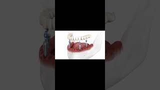 যাদের একটাও দাঁত নাই তাদের কি ভাবে দাঁত লাগানো হয়#dentaltreatm #dentist #smilemakeover