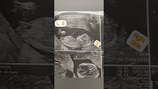NT scan report girl baby#NT scan#boy baby#girl baby#