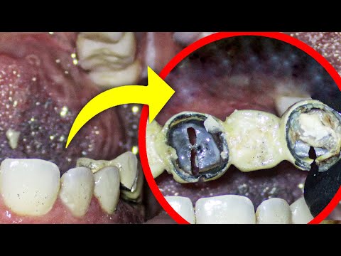 Removal of Old Crowns, Anchor Post Extraction, and Root Canal Retreatment