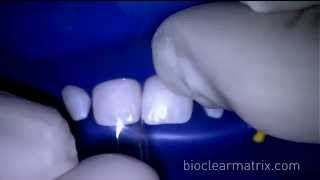 Bioclear Composite Veneers for post orthodontic undersized teeth. Part 1
