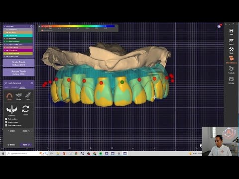 All-on-6 Design with Impression Scan Bodies
