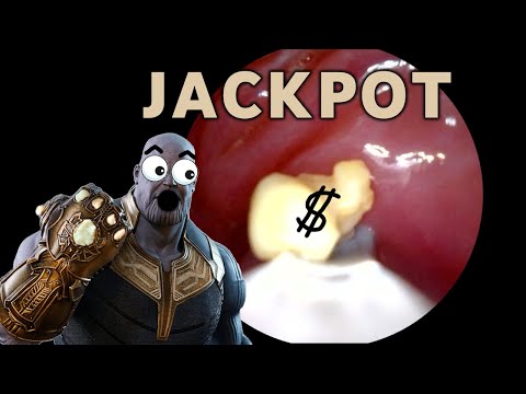 My MILLIONTH Tonsil Stone?! | AIM 33