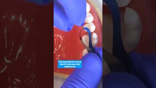 A quick demo of how to place our margin elevation bands. To order click the 🔗 in bio.