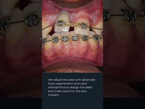 Real transformations take time and expertise (Dr. Juan Fernando Uribe, Cali Dentist)