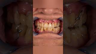 Replacement of missing teeth | Your Dentist | #shorts #shortvideo #prosthesis