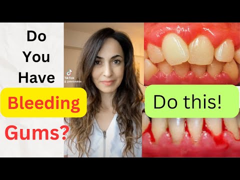 Do You Have Bleeding Gums? Here is what you need to do!