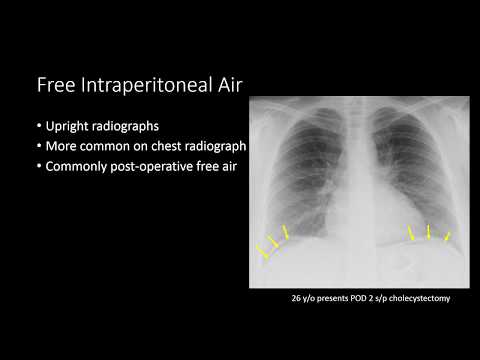 Managment of Free Intraperitoneal Air on Radiographs