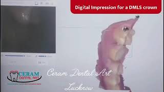 Digital Impression for a DMLS crown