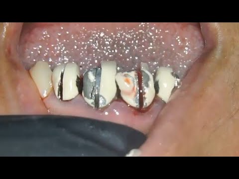 PERFECT!! OLD CROWN REMOVAL