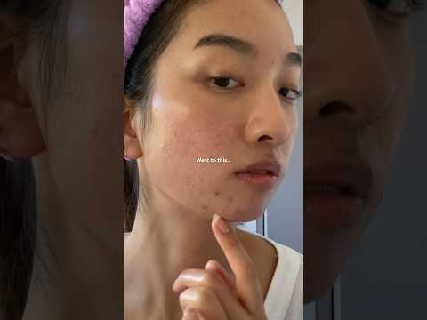 Breaking out yesterday, today, and tomorrow 🤭#skinpositivity #acne #short