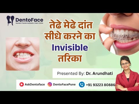 तेधेमेधे दांत सीधे करनेका invisible तारिक @AskDentoface-tc9xs - Dr.Arundhati