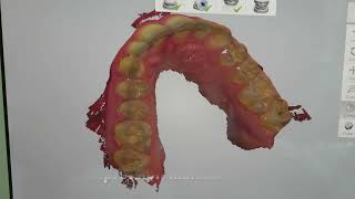 digital impression on single implant