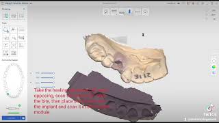 Medit i700 Scanning for an implant restoration