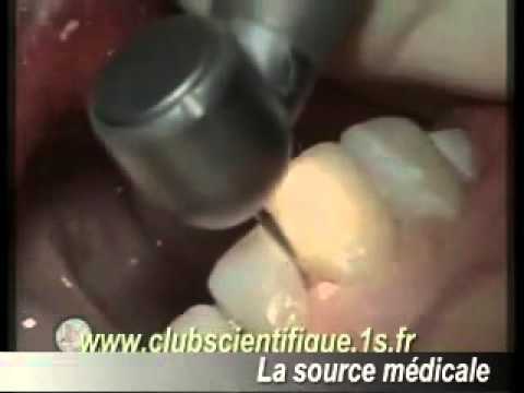 Filtek Z550 (Филтек Z550)
