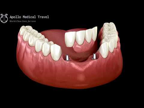 Animated Partial Fixed Denture Procedure | Apollo Medical Travel