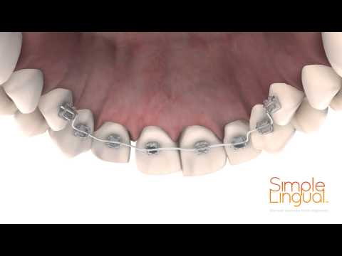 Cfast Discreet Cosmetic Tooth Alignment Animation