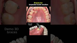 Braces pull impacted tooth #braces #dentist #orthodontist