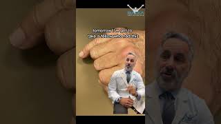 Don't ignore a finger fracture! Dr.Badia Explains why you should see a specialist