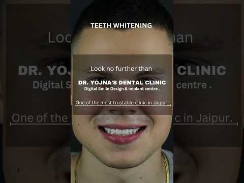 Digital Smile design in jaipur. #PorcelainVeneers  #SmileDesign #DentalImplant #Braces