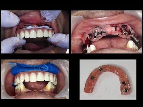 Graphene _ All on 6 Prosthesis case presentation by Asian Dental Academy