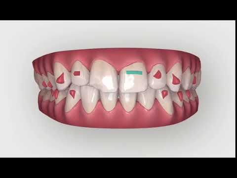 Invisalign Tooth Movement - JB White DDS Las Vegas