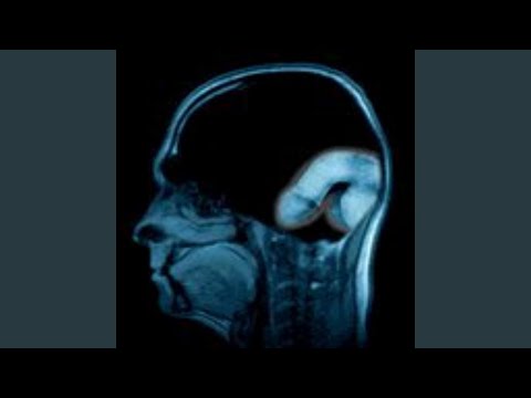 Broken Bones minor changes