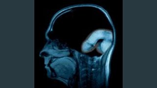 Broken Bones minor changes