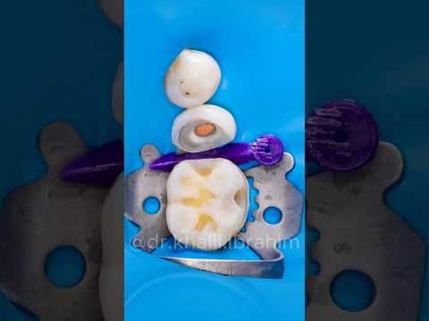 Root Canal + Composite filling (single visit)