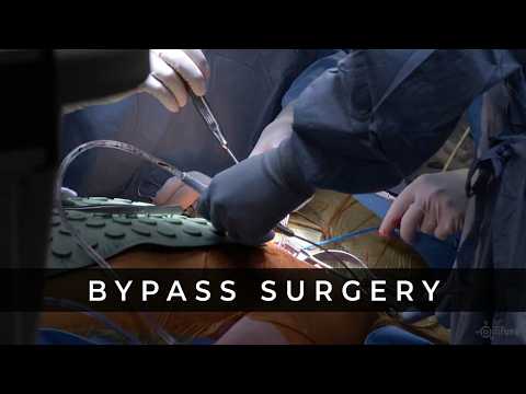 Bypass Surgery side view - Infuse Medical