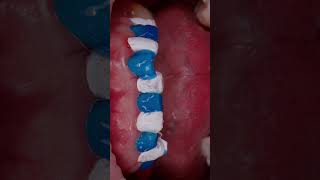 Flowable Composite Injection Technique #dentistry #restorativedentistry #prosthodontic #dental