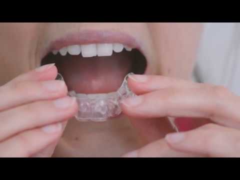 What are retainers?