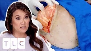 Dr. Lee Removes HUGE Lipoma From Patients Shoulder | Dr. Pimple Popper: Pop Ups