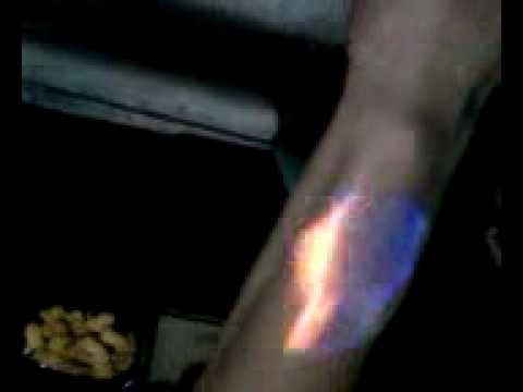 My arm on fire