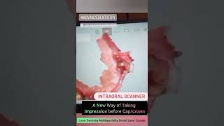 New and Advanced  Digital Dental Impression