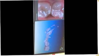 Dr Cohen's digital impression video