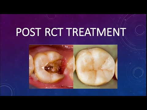 POST RCT TREATMENT