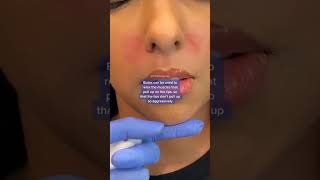 Gummy Smile Correction with #Botox