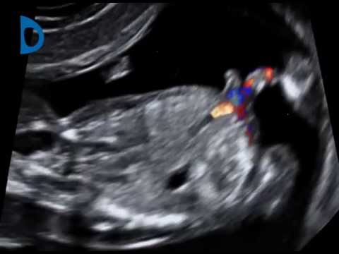 Fetal Medicine Foundation - umbilical cord duplication at 12 weeks